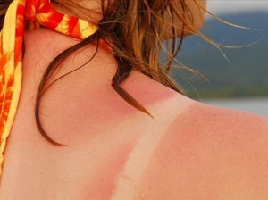 Обгорело лицо на солнце что делать. Красная кожа от загара. Обгорелая кожа от солнца. Экстремальный загар.